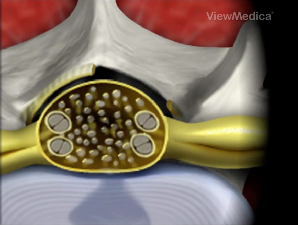 12-O-endoscopio-e-retirado-e-as-estruturas-neurais-retornam-a-sua-posicao-anatomica-1024x774 Cirurgia Endoscópica