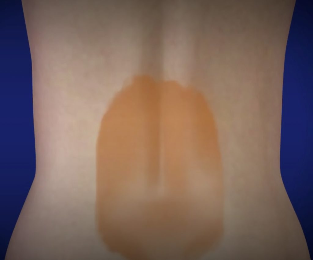 2-Posicao-inicial-deitado-decubito-ventral-1024x850 Cirurgia Endoscópica