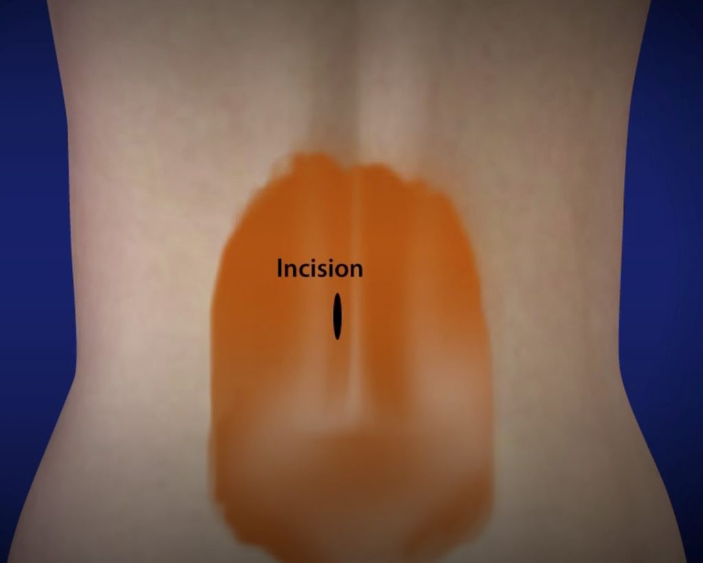 3-Incisao-1024x820 Cirurgia Endoscópica