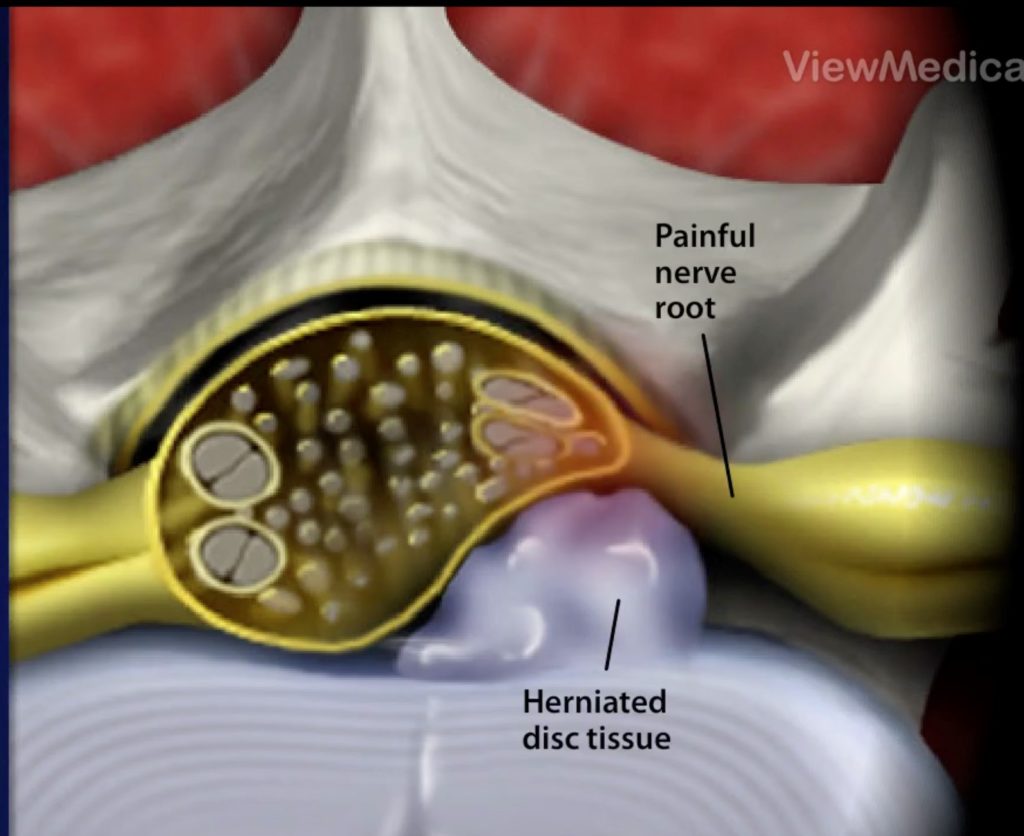 5-Ampliacao-do-corte-axial-1024x836 Cirurgia Endoscópica
