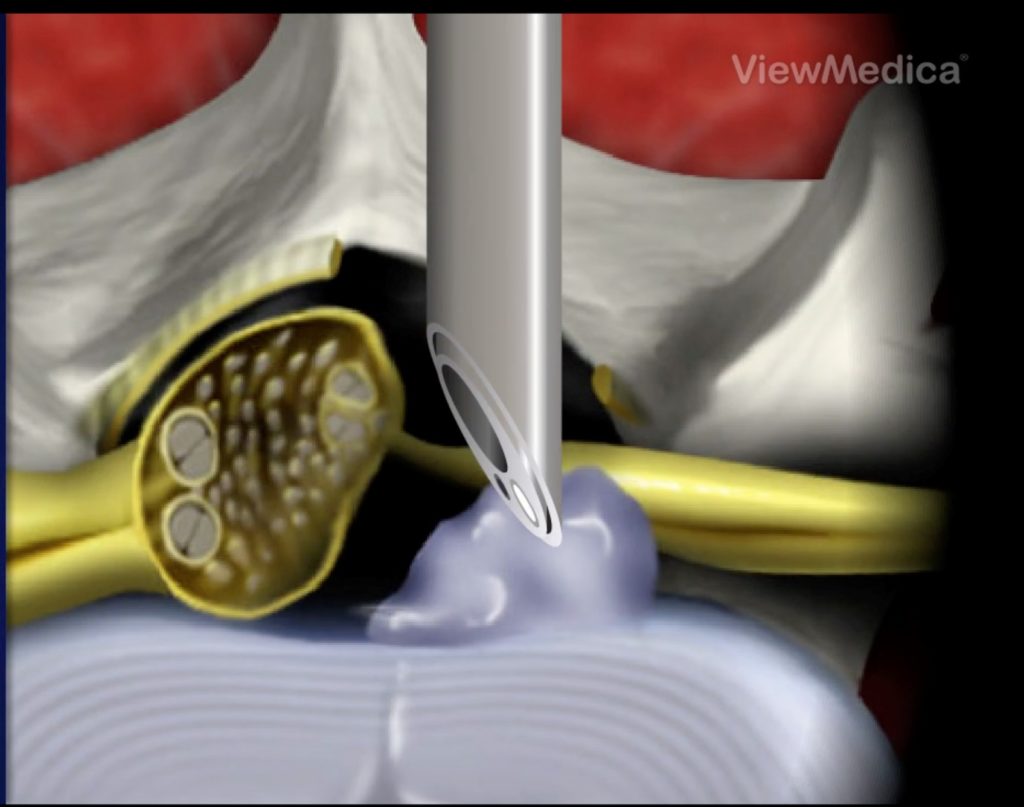 6-Colocacao-do-endoscopio-entre-a-hernia-e-os-nervos-1024x807 Cirurgia Endoscópica