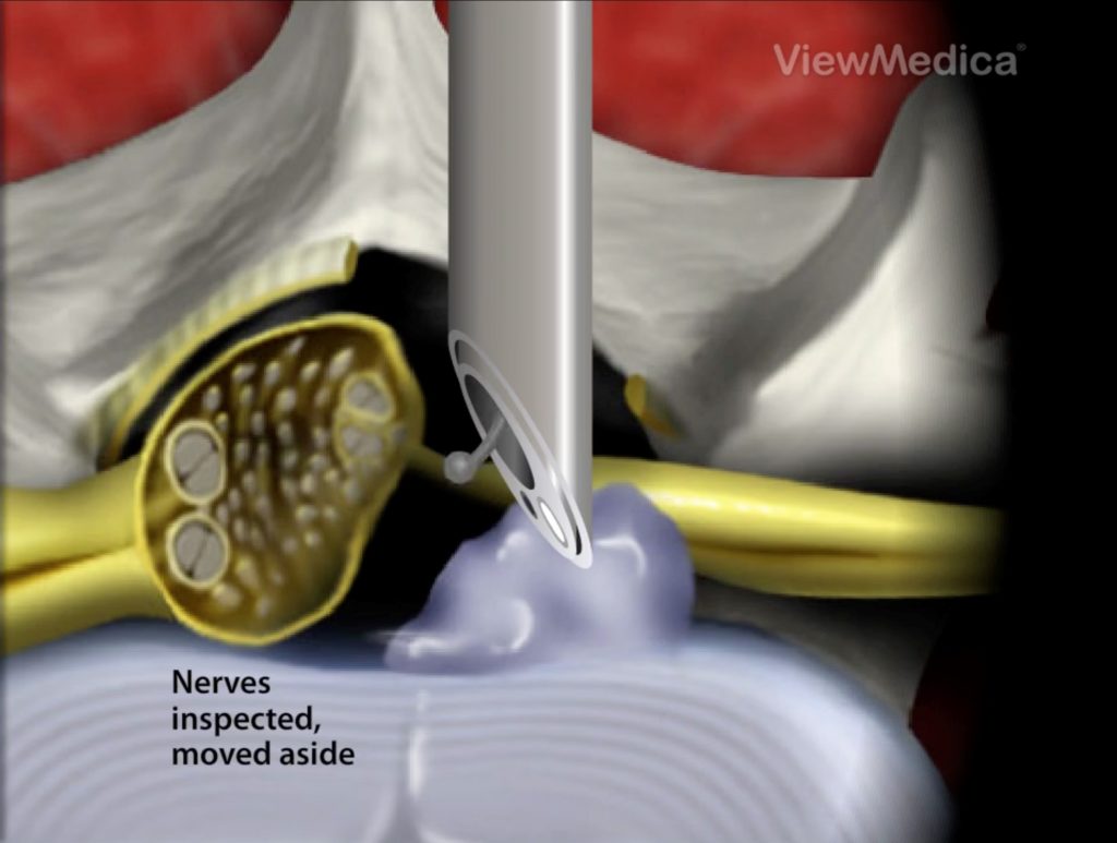 8-Inspecao-e-afastamento-dos-nervos-com-instrumental-especifico-1024x773 Cirurgia Endoscópica